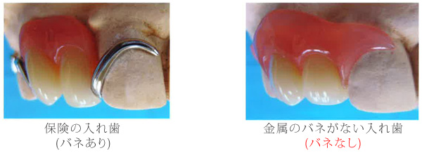 保険の入れ歯（バネあり）金属のバネがない入れ歯（バネなし）